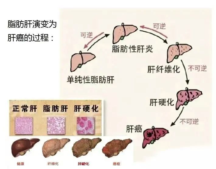 脂肪肝的克星：三七脂肝丸