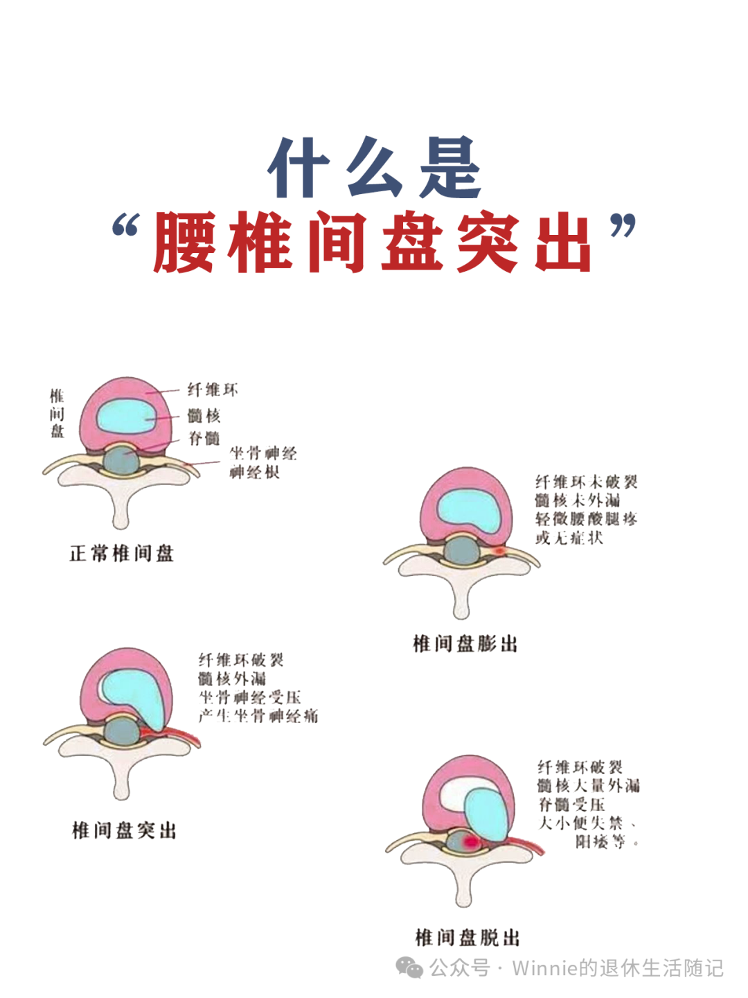 巧治腰椎间盘突出  倒走