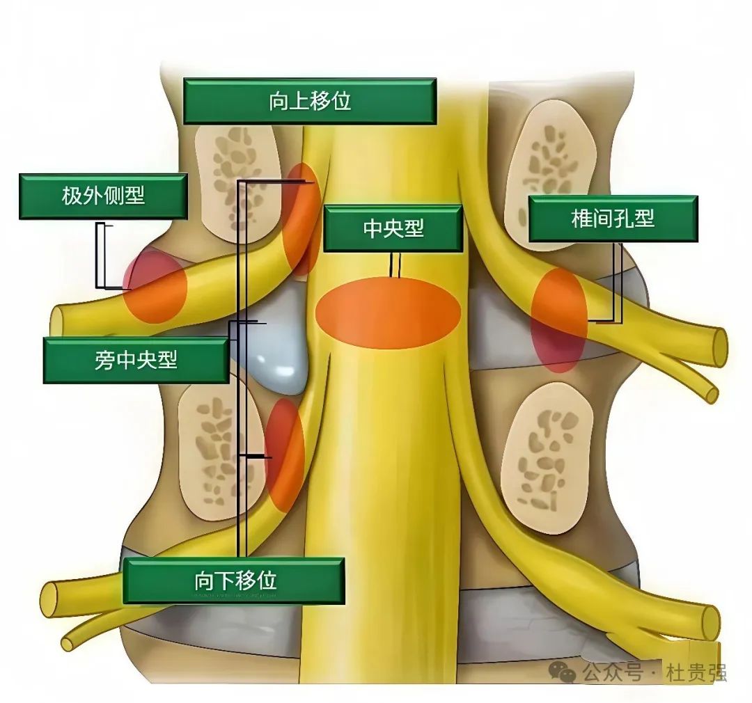 腰椎间盘突出症
