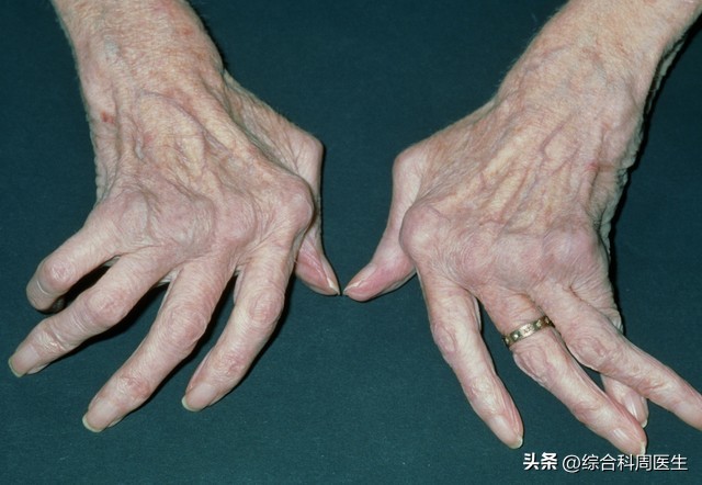 重磅突破！类风湿迎来细胞新疗法，七成患者症状大幅改善